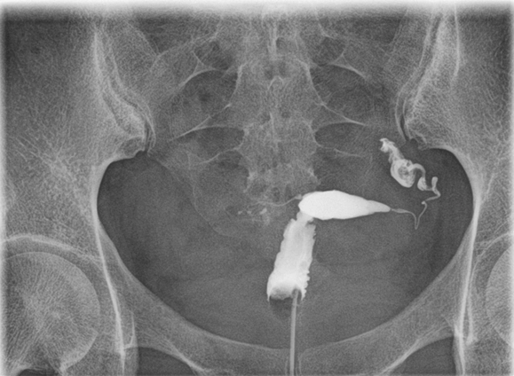 Viêm dạng nốt đoạn eo vòi trứng (Salpingitis isthmica nodosa)