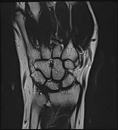 Hội chứng kênh Guyon (Guyon's canal syndrome)