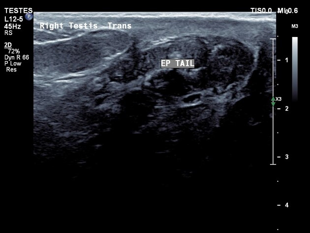 U hạt tinh trùng (Sperm granuloma)