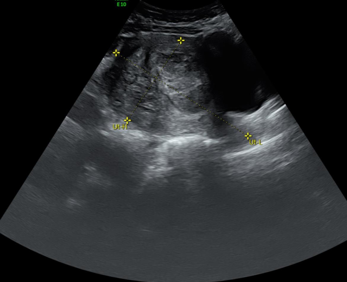 U mô đệm nội mạc tử cung (Endometrial Stromal Tumors - EST)
