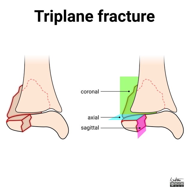 Gãy ba mặt phẳng đầu dưới xương chày (Triplane fracture)