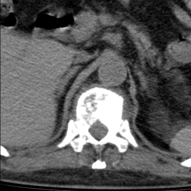 Di căn xương hỗn hợp (Mixed lytic and sclerotic bone metastases)