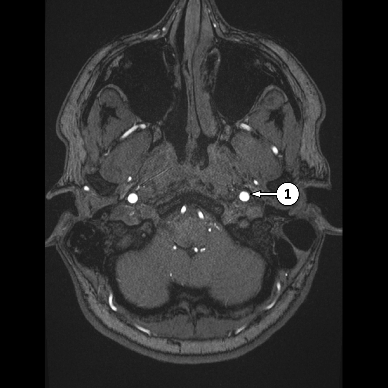 MRA (MRI mạch máu)