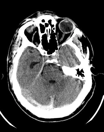 Dấu hiệu dây thừng trong huyết khối xoang tĩnh mạch màng cứng (Cord Sign)