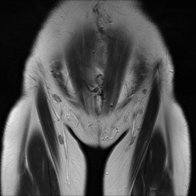 U cơ trơn di căn lành tính (Benign metastasizing leiomyoma)