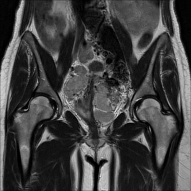 U cơ trơn di căn lành tính (Benign metastasizing leiomyoma)