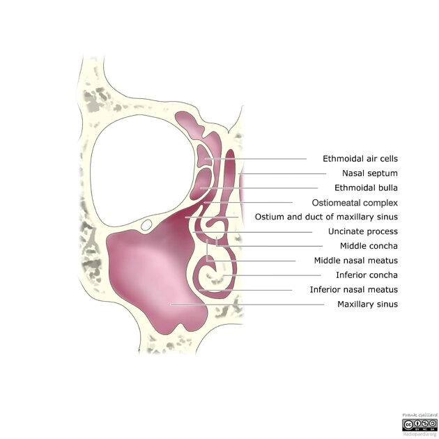 Hội chứng xoang im lặng (Silent sinus syndrome - SSS)