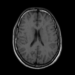 Nhồi máu não do thuyên tắc mỡ (Fat Emboli Cerebral Infarction)