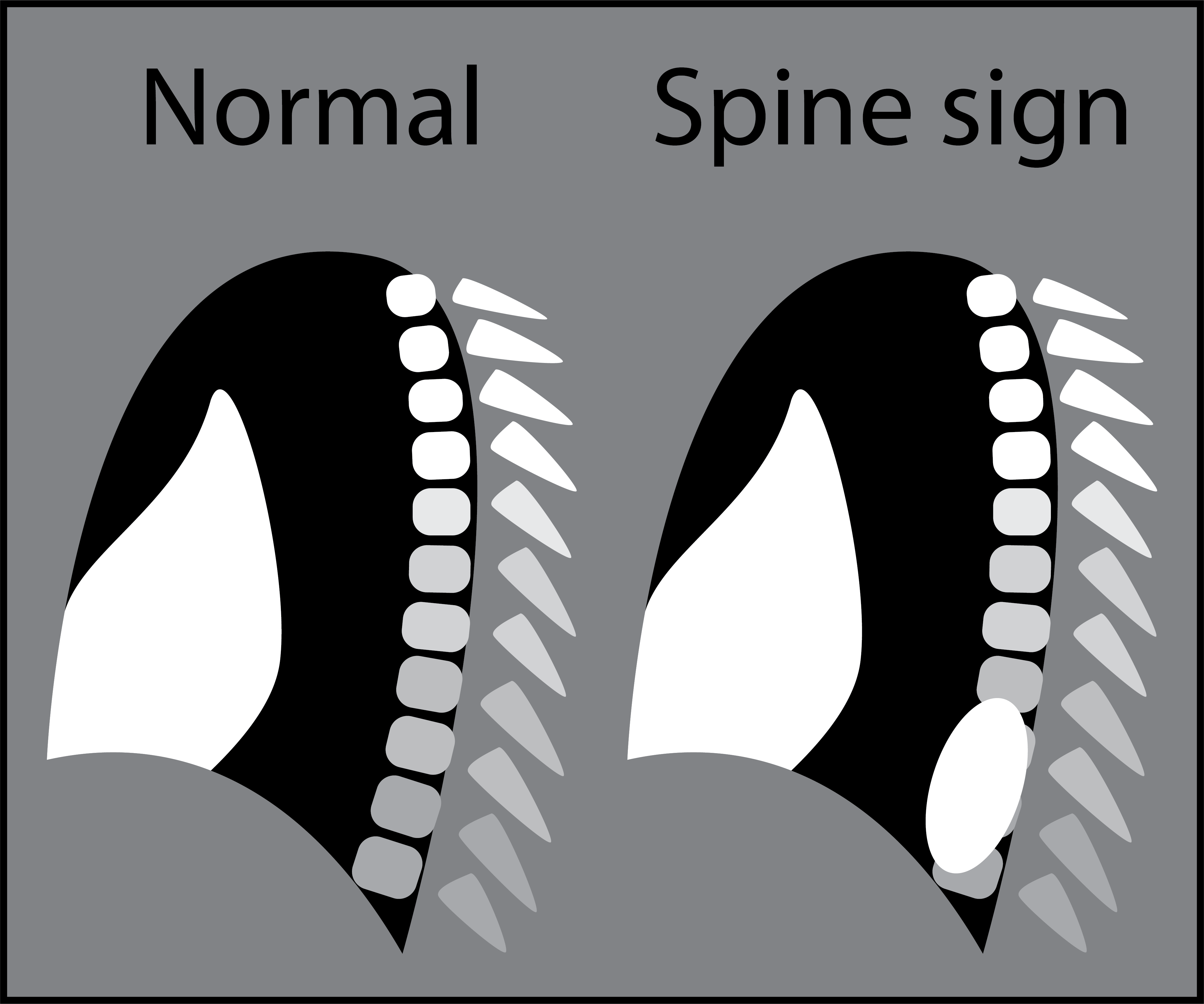 Dấu hiệu cột sống (Spine sign)