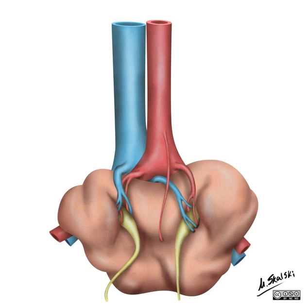 Thận hợp nhất lạc chỗ vùng chậu (Pancake kidney)