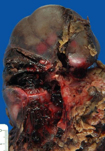 Chấn thương thận (Renal trauma)