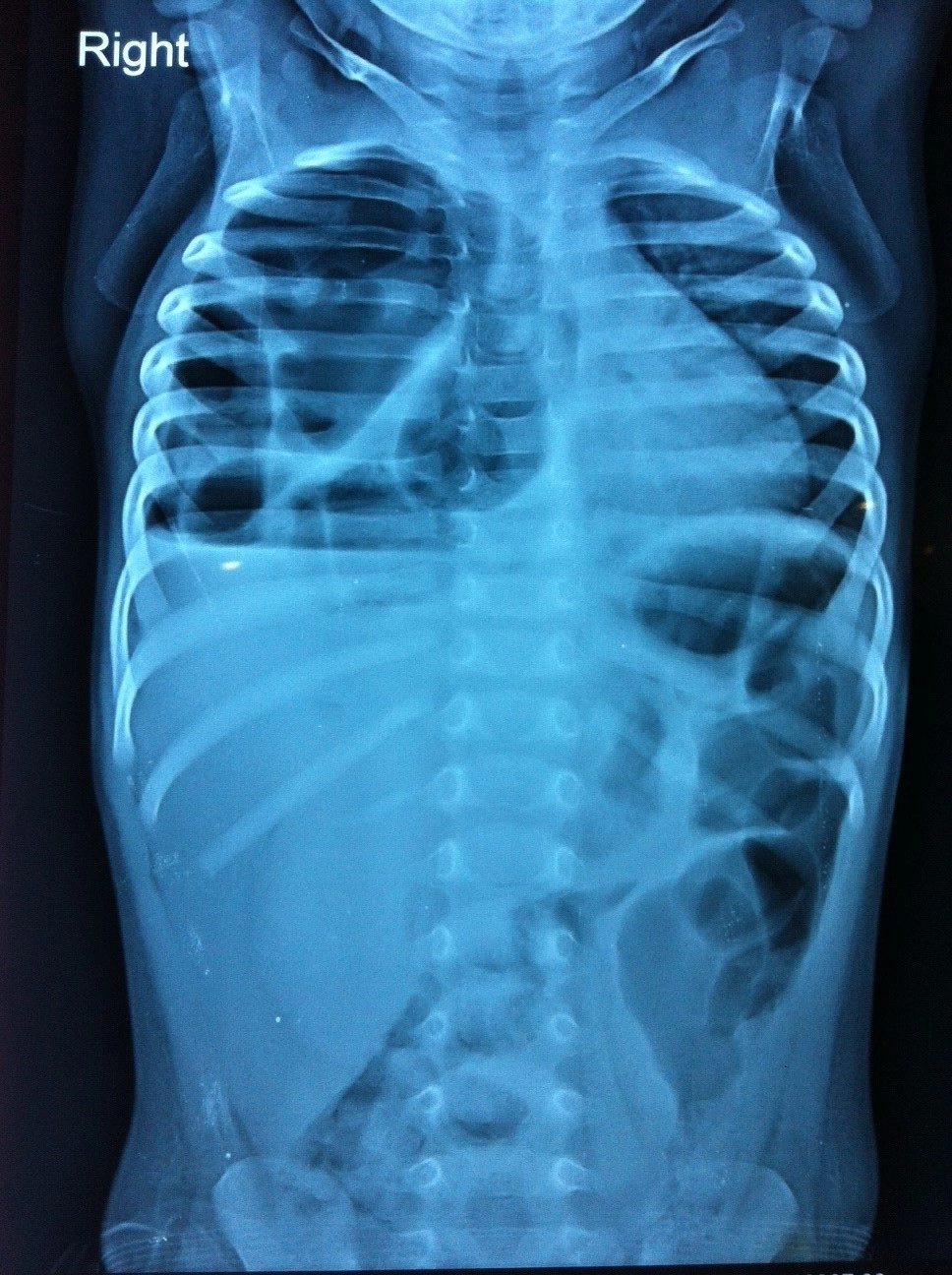 Dị dạng đường thở phổi bẩm sinh (Congenital Pulmonary Airway Malformation - CPAM)