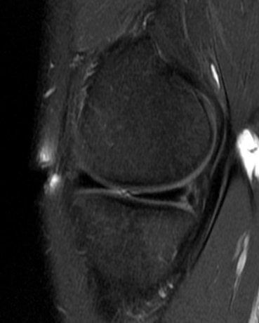 Nếp gấp sụn chêm (Meniscal flounces)