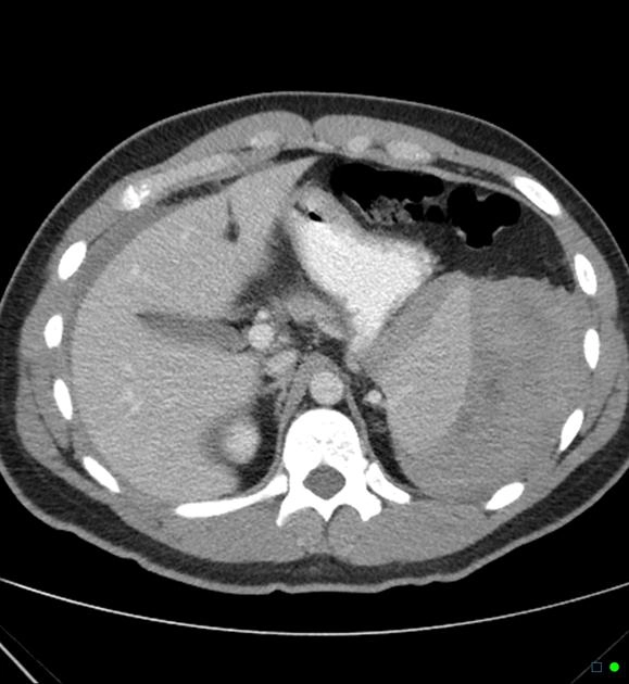Vỡ lách tự phát (Spontaneous splenic rupture)