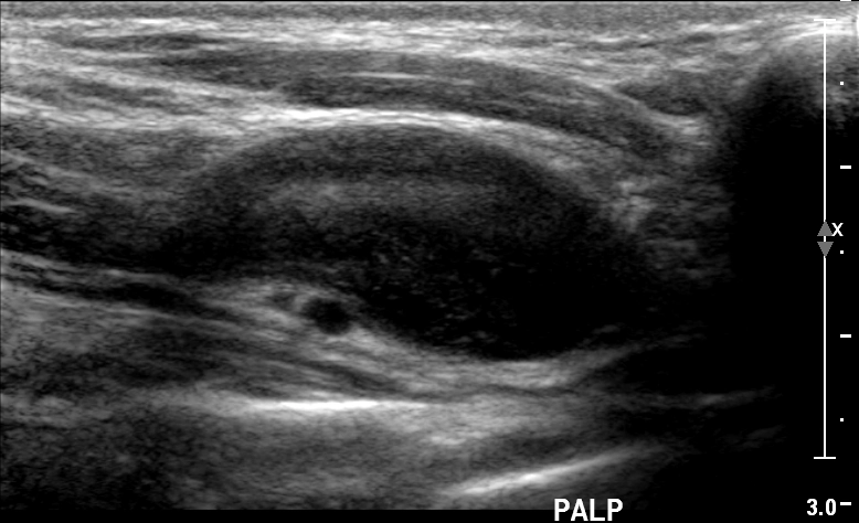 Schwannoma đám rối cánh tay (Brachial Plexus Schwannoma)