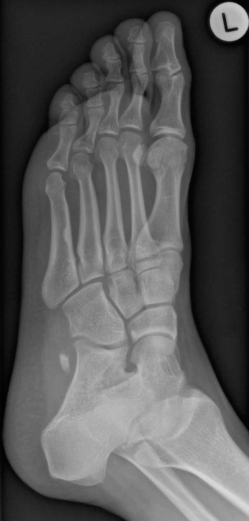Rách gân cơ mác dài (Fibularis longus tendon tears)