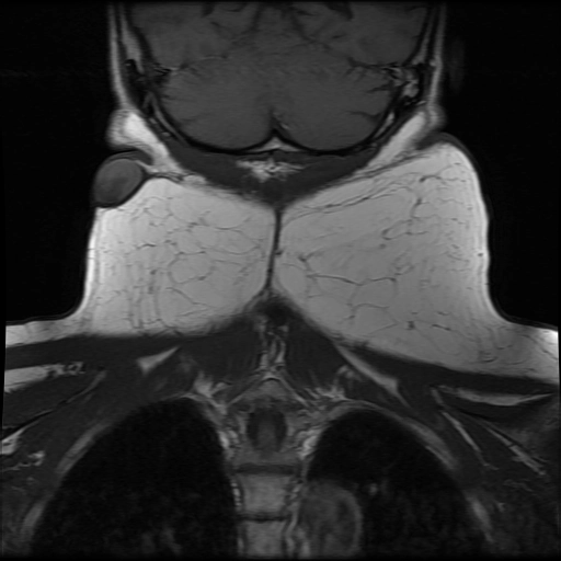 Lắng đọng mỡ (Lipomatosis)