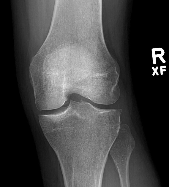 Cốt hóa sụn chêm (Meniscal ossicle)