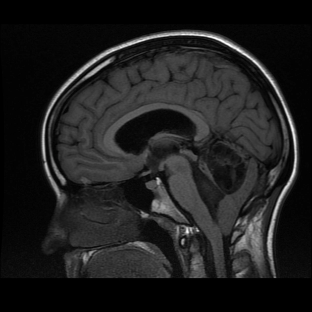 U tế bào thần kinh đệm hình hoa hồng (Rosette-forming glioneuronal tumors - RGNT)