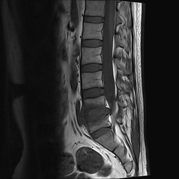 Viêm đốt sống sinh mủ (Pyogenic spondylitis)