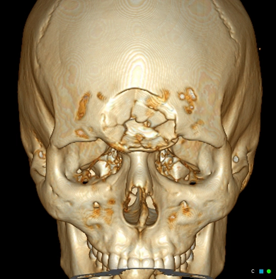 Gãy xoang trán (Frontal sinus fractures)