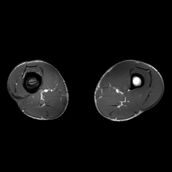 Mảnh xương chết (Sequestrum)