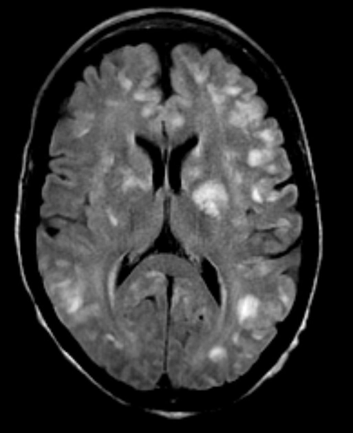 Viêm động mạch nguyên phát hệ thần kinh trung ương (Primary Arteritis of the Central Nervous System- PACNS)