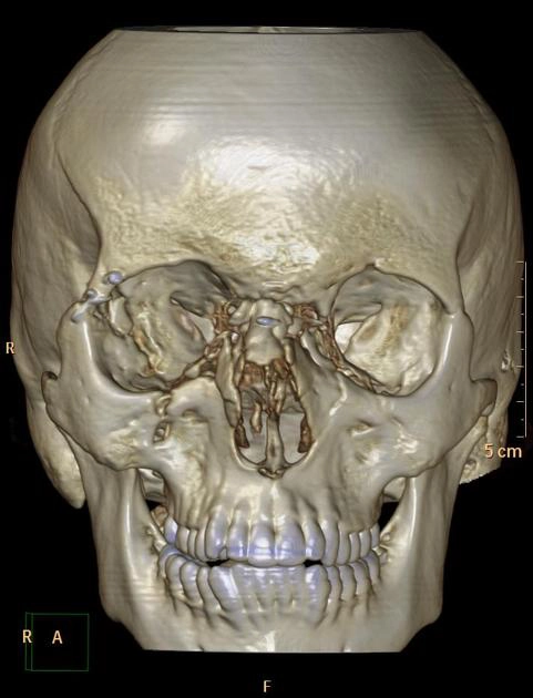 Gãy phức hợp mũi sàng ổ mắt (Naso-orbitoethmoid (NOE) complex fracture)
