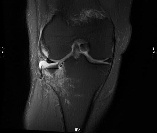 Bong sụn chêm (Floating meniscus)