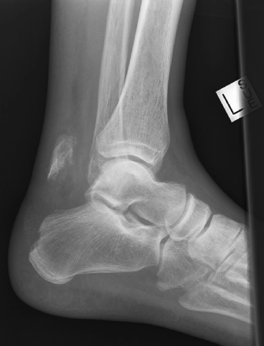 Gãy bong lồi củ xương gót (Calcaneal tuberosity avulsion fracture)