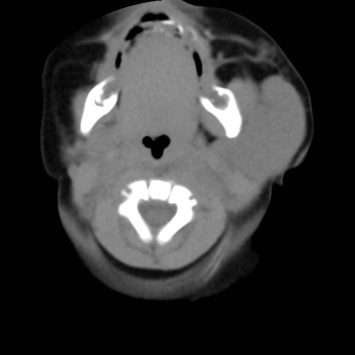 U máu tuyến mang tai ở trẻ sơ sinh (Parotid infantile hemangioma)