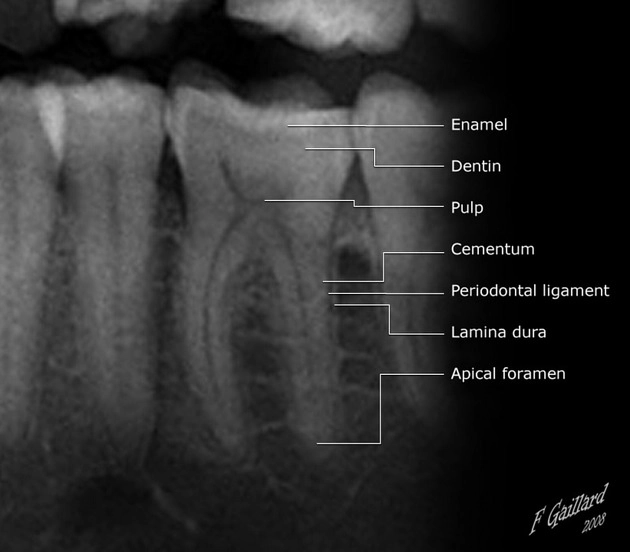 Nang quanh chóp (Periapical cysts)