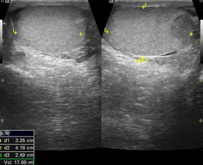 Chấn thương tinh hoàn (Testicular trauma)