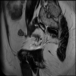 Ung thư hậu môn (Anal cancer)