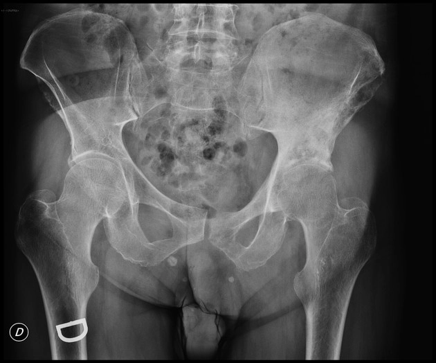 U lymphoma nguyên phát tại xương (Primary Bone Lymphoma - PBL)