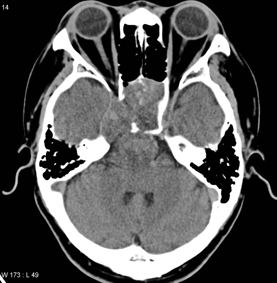 U vùng dốc nền (Clival masses)