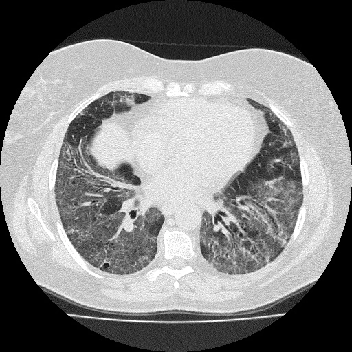 Viêm phổi kẽ không đặc hiệu (Non-specific interstitial pneumonia - NSIP)