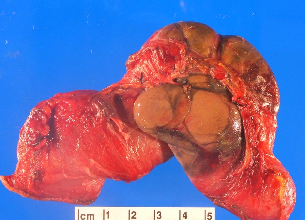 Viêm phúc mạc xơ hóa kén bọc (Encapsulating peritoneal sclerosis)