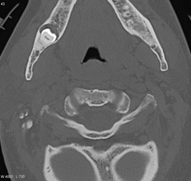 Nang thân răng (Dentigerous cysts)