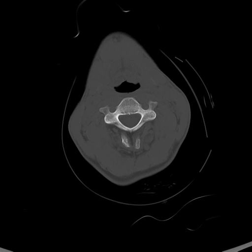 Gãy xương xoang cạnh mũi (Paranasal sinus fractures)