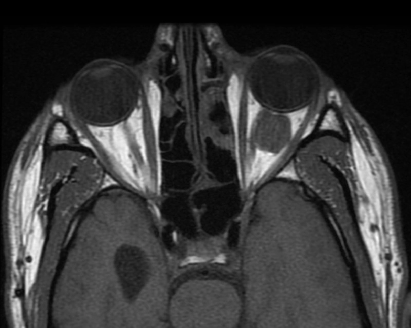 Dị dạng tĩnh mạch thể hang ở ổ mắt (Orbital cavernous venous malformations)