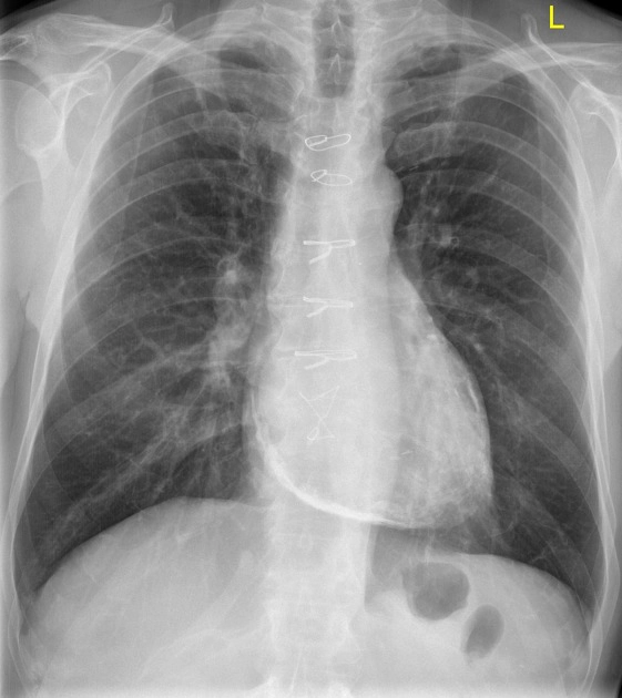 Viêm màng ngoài tim co thắt (Constrictive Pericarditis)