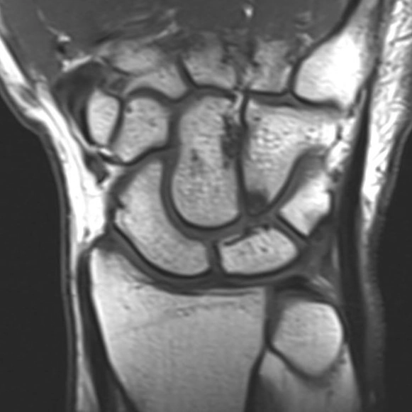 Hội chứng chẹn móc-nguyệt (Hamatolunate impingement)