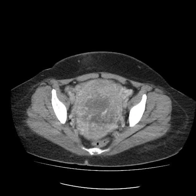 Choriocarcinoma thai kỳ (Gestational choriocarcinoma)