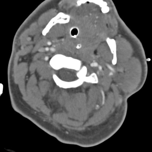 Thang điểm Biffl phân loại tổn thương mạch máu não do chấn thương cùn (Blunt Cerebrovascular Injury - BCVI)