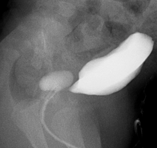 Nang túi bầu dục tuyến tiền liệt (Prostatic utricle cyst)