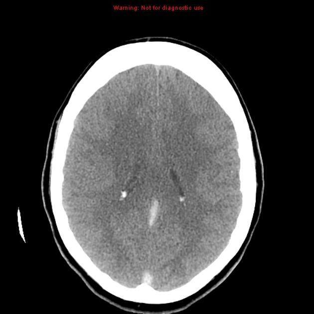 Dấu hiệu Tĩnh mạch Tăng Đậm Độ trong Huyết khối xoang tĩnh mạch màng cứng(Dense Vein Sign)
