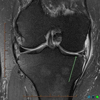  Rách xuyên tâm sụn chêm (Radial meniscal tear)