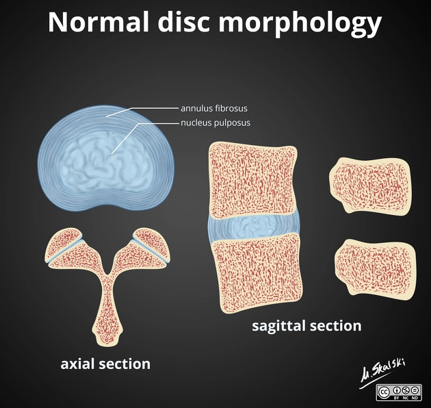 Phình đĩa đệm (Disc bulge)