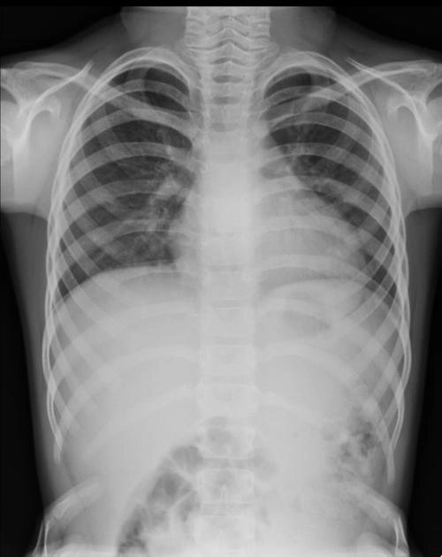 Lồng ngực ức gà (Pectus Carinatum)